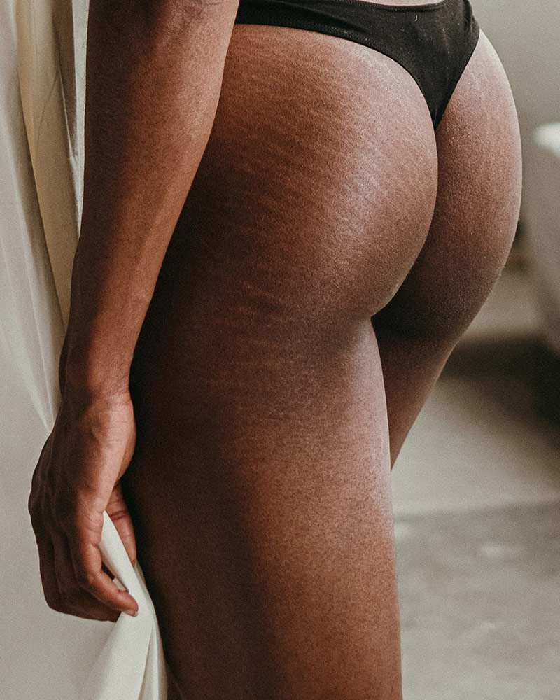 Cuerpo femenino raza negra con estrías en la piel